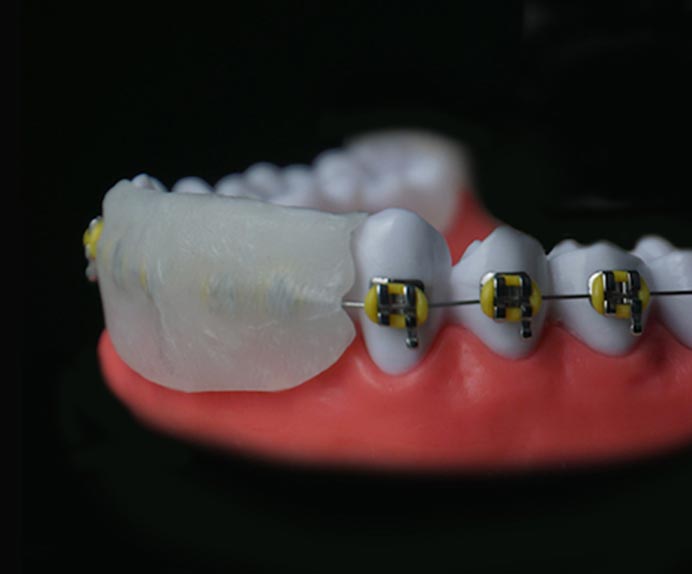 Protège-dents flexible et remoulable pour une protection optimale -  plusieurs coloris